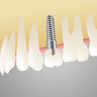 Implantate - im Knochen befestigt